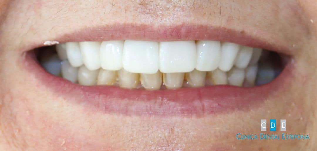 Porcelain Veneers — Before