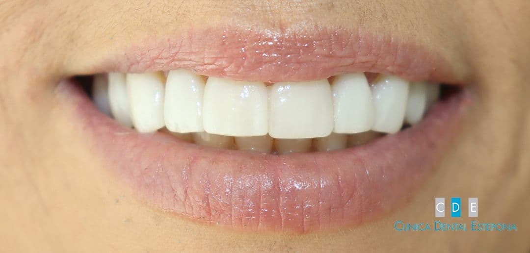 Porcelain Veneers — After